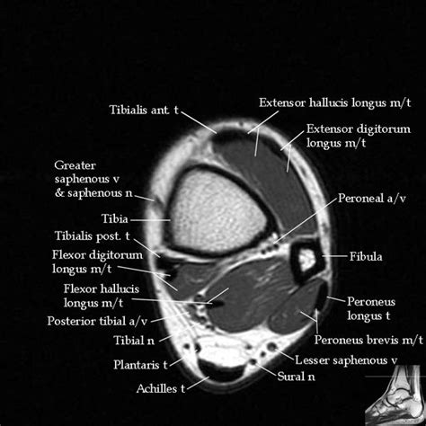 Mri Ankle Anatomy Ankle Anatomy Mri Radiology Imaging
