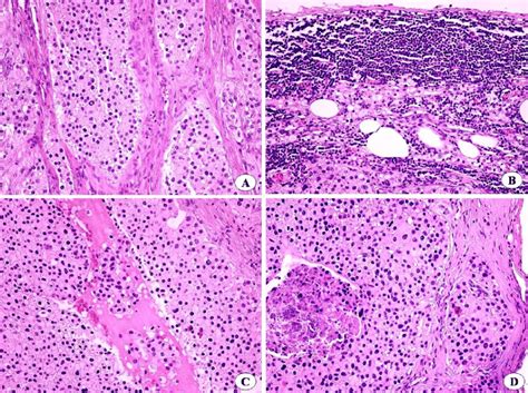 Second Metastasis Of The Parathyroid Carcinoma In Lymph Node A The