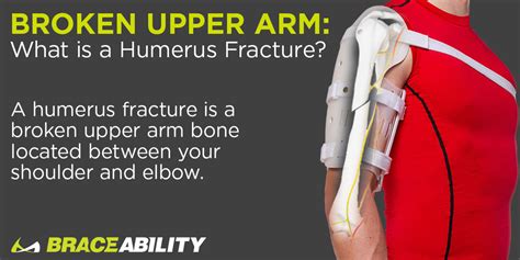 Sarmiento Brace High Quality Humerus Fracture Splint Support