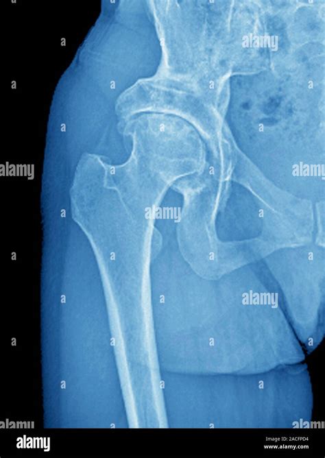 Coloured X Ray Of The Hip Of A Patient Aged 54 Showing Osteoarthritis
