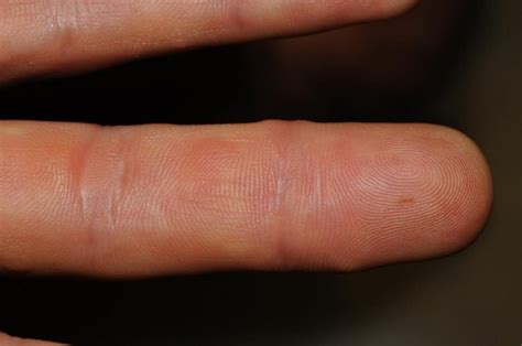 45 Year Old Male With Tender Papules On Palms And Soles The Doctors