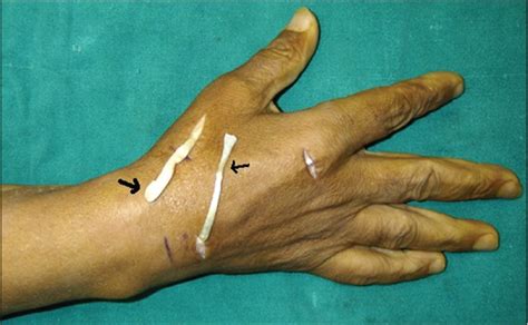 Thumb Extensor Tendon Epl Rupture Hand2shoulder Clinic