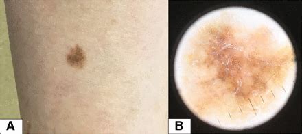 Lateral sections revealed persisting in situ melanoma, which were again excised. The dilemma of whether to continue TNFα blocker therapy in ...