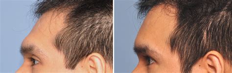 Forehead Augmentation Brow Bine Reduction Result Side View Dr Barry