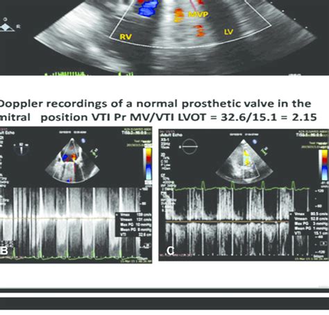 Well Functioning Mitral Valve Prosthesis With Physiological Jet Upper