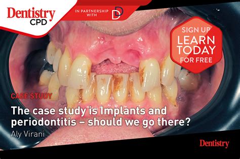 Dentistry Cpd New This Week Implants And Periodontitis Dentistry