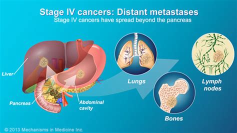 Pancreatic Cancer Pathophysiology Diagnosis And Staging