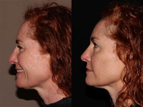 Bbl Photofacial Before And After Pictures Case 8 Chico Yuba City