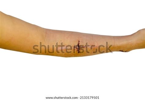 Stitches After Surgery Isolated Background Stock Photo 2133179501