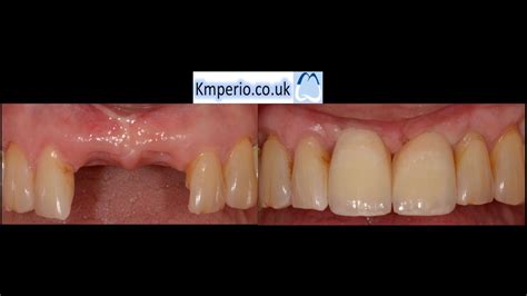Dental Implant For Upper Front Teeth Start To Finish Youtube