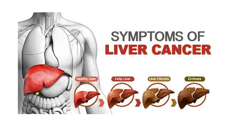 Liver Cancer Can Be Prevented By Avoiding Alcohol Abuse Occurrence