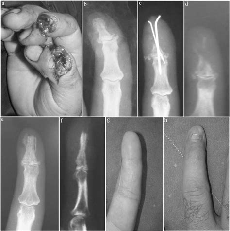 Treatment Of Nonunions Of The Distal Phalanx With Olecranon Bone Graft