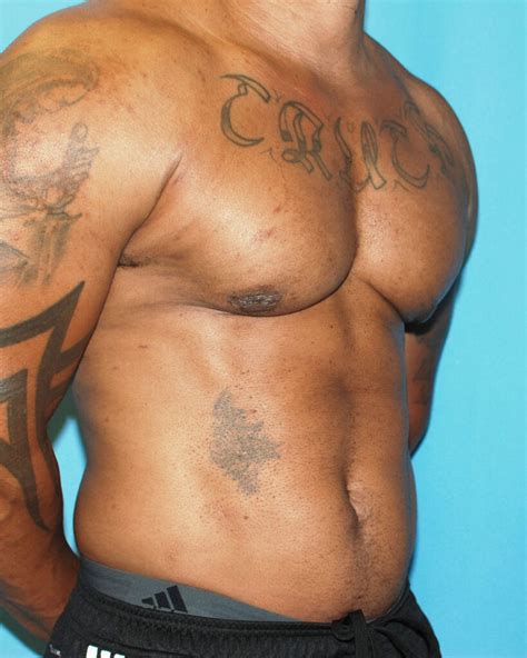 Bodybuilder Gynecomastia Before After 57 Chicago Breast And Body