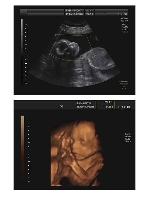 Gambar Bayi Dalam Kandungan 3 Bulan Pulp
