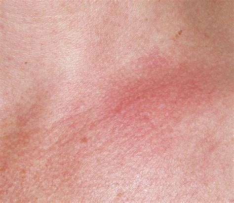 Lupus Rash On Neck And Chest