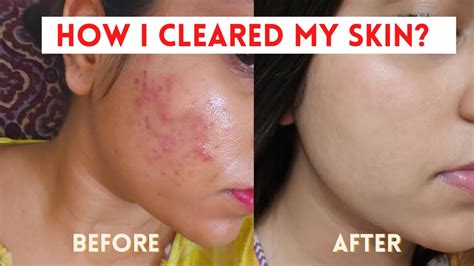 My Acne Journey Accutane Isotretinoin Before And After Severe Hormonal Cystic Acne Youtube
