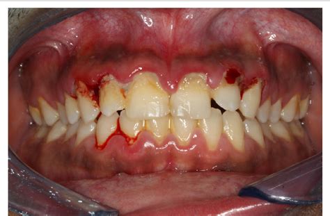Icd Code Of Acute Necrotizing Ulcerative Gingivitis And Icd Code Hot