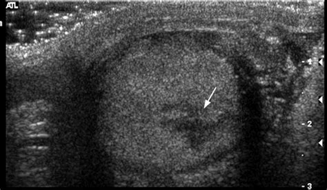 Us Of Acute Scrotal Trauma Optimal Technique Imaging Findings And