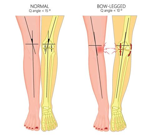 Bow Legs Genu Varum Causes And Symptoms Parkway East Hospital