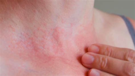 Dermatitis Dermatology Footage Videos And Clips In Hd And 4k
