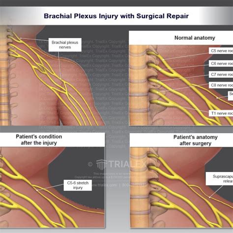 Brachial Plexus Injury With Surgical Repair Trialexhibits Inc