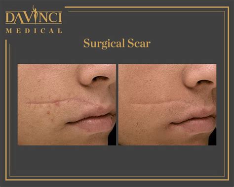 Da Vinci Clinic Acne Scars Treatment Using Fotona Sp Dynamis Pro Laser