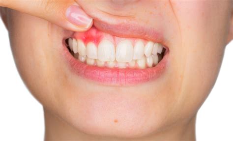 Dental Specialties Institute Inc Signs And Symptoms Of Gingivitis