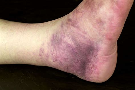 Bruised Heel Bone Or Something More Serious Invigor Medical