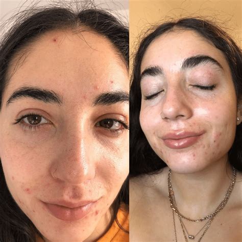 My Accutane Journey And Experience With Isotretinoin Breakeven