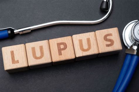 Foto Kenali Apa Itu Penyakit Lupus Penyebab Dan Komplikasinya Sexiz Pix