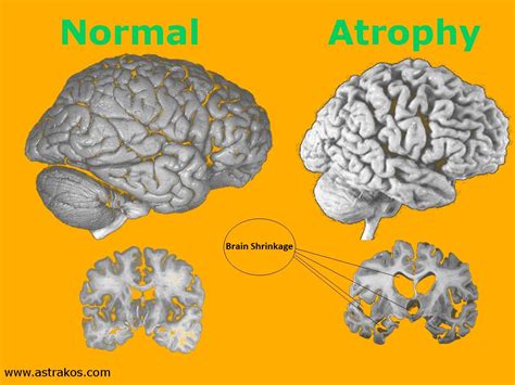 Understanding Cerebral Atrophy And Brain Health