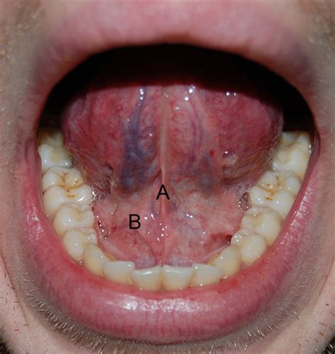 Glandula Sublingual Inflamada