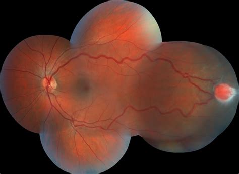 Retinal Capillary Hemangioma Retina Image Bank