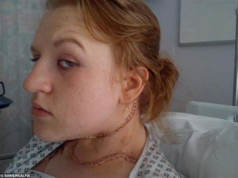 Student Left Looking Like ‘real Life Frankenstein After Op To Remove