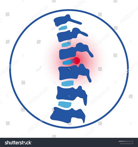 Spinal Disc Herniation Images Stock Photos Vectors Shutterstock