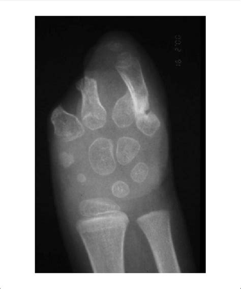 Radiograph Of The Hand Prior To Reconstruction Download Scientific