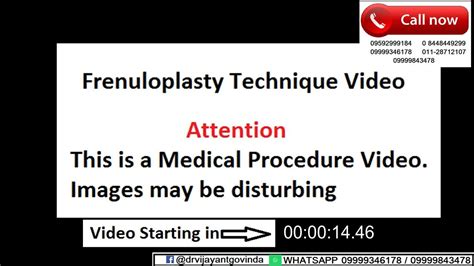 Stitchless Frenuloplasty In India Surgery For Frenulum Breve Tight Frenulum Youtube