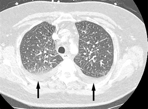 Review Of The Chest Ct Differential Diagnosis Of Ground Glass Opacities
