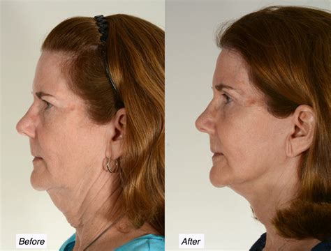 How To Get Rid Of Your Turkey Neck Charleston Facial Plastic Surgery