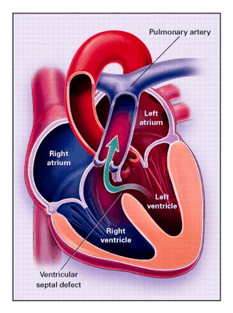 Left heart hypoplasia syndrome — a form of congenital heart. Biology Forum | Biology-Online Dictionary, Blog & Forum