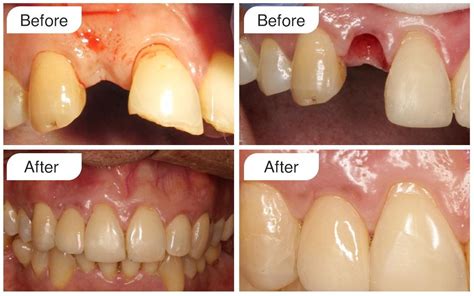 Cdic Before And After Cosmetic Dental Implant Centre Cdic Wakad