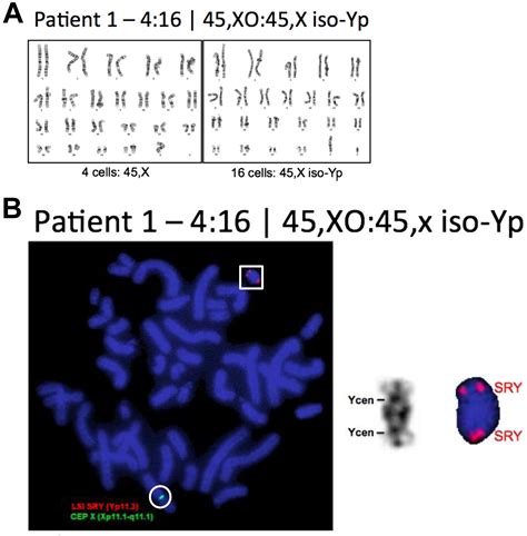 Complexity In The Diagnosis And Management Of 45 X Turner Syndrome