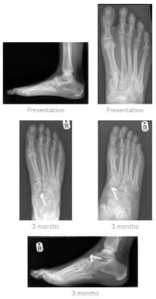 Transform Talonavicular Joint Arthritis Surgical Treatment