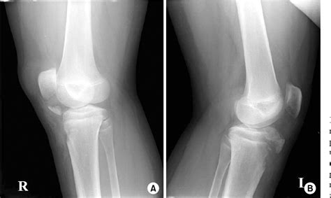 Figure From Operative Treatment Of Bilateral Tibial Tuberosity