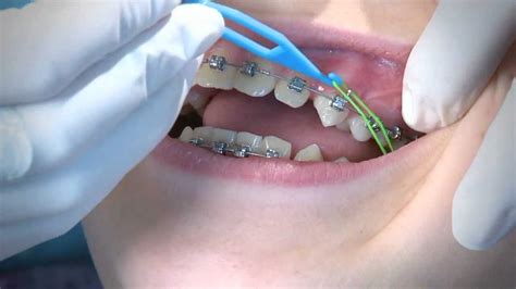 Correcting posterior crossbite by elastics (rubber bands) in orthodontic treatment. ELÁSTICOS NO TRATAMENTO ORTODÔNTICO ~ Ortodontia em Brasília