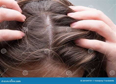 Close Up Of Woman Examining Her Scalp And Hair Hair Loss On Hairline