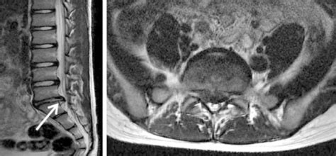 T2-weighted sagittal and axial magnetic resonance image ...