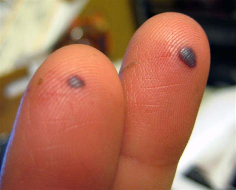 5 Things You May Not Have Known About Blood Blisters