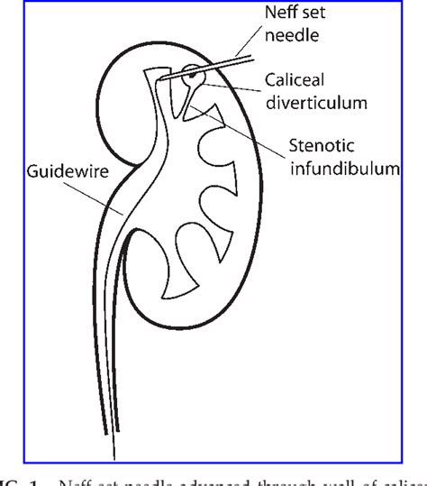 Figure 1 From Percutaneous Nephrolithotomy Of Caliceal Diverticular