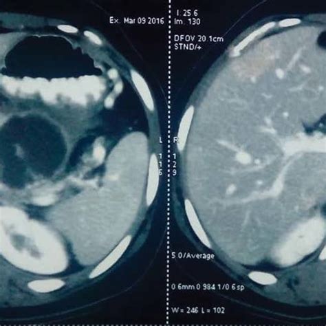 A And 1b Cect Showing Pancreatic Cyst With Loss Of Fat Planes With